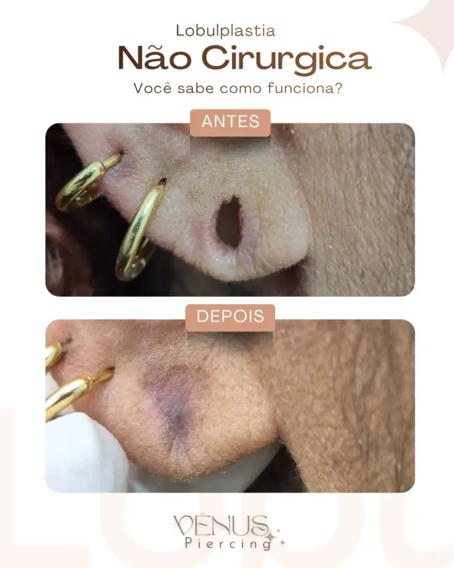 Lobuloplastia não cirúrgica