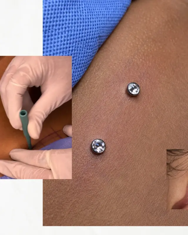 Microdermal